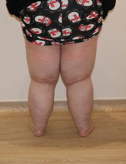 Lower limb lipoedema liposuction after posterior view