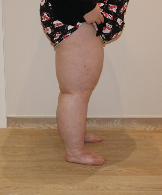 Lower limb lipoedema liposuction after right lateral
