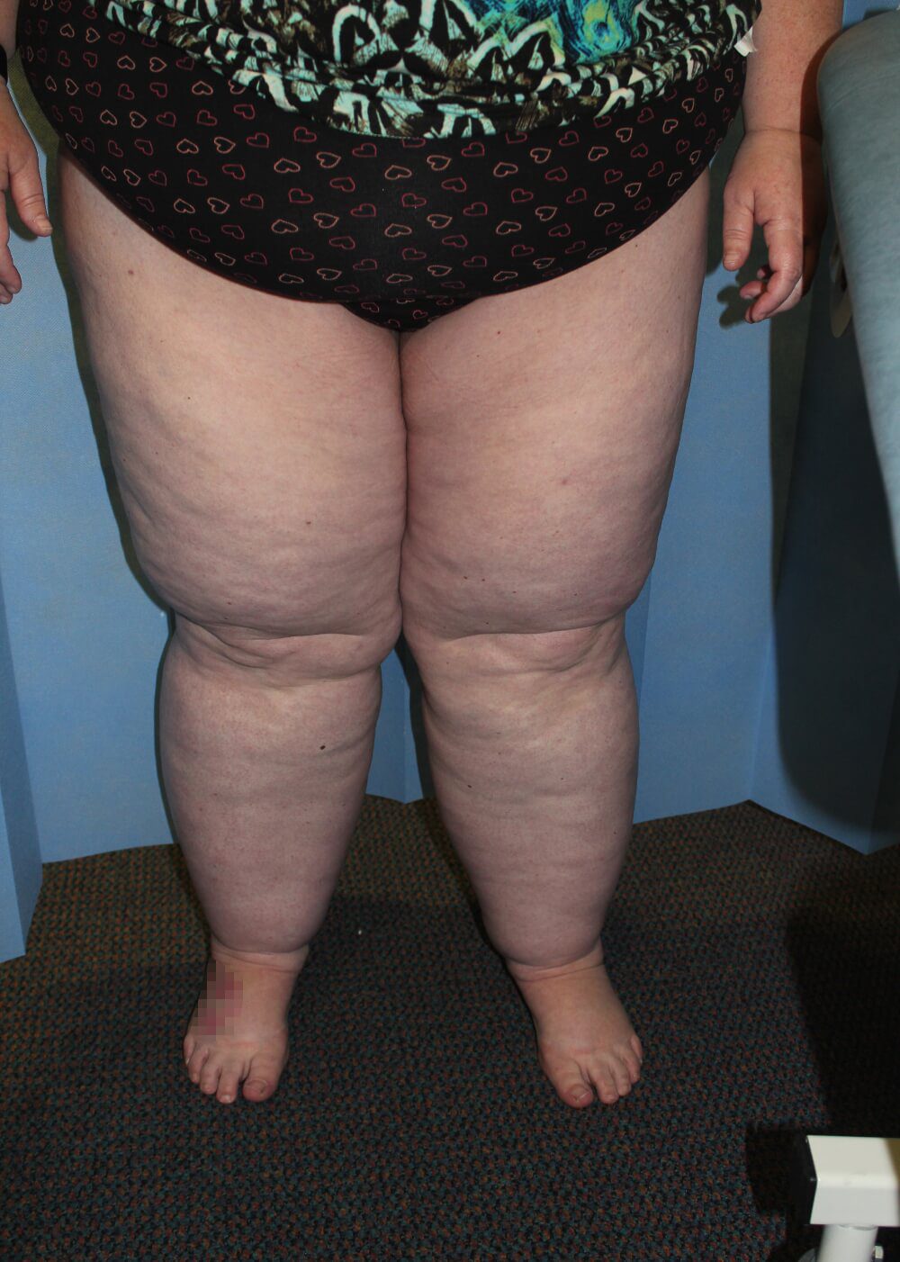 Lower limb lipoedema liposuction before AP view 1