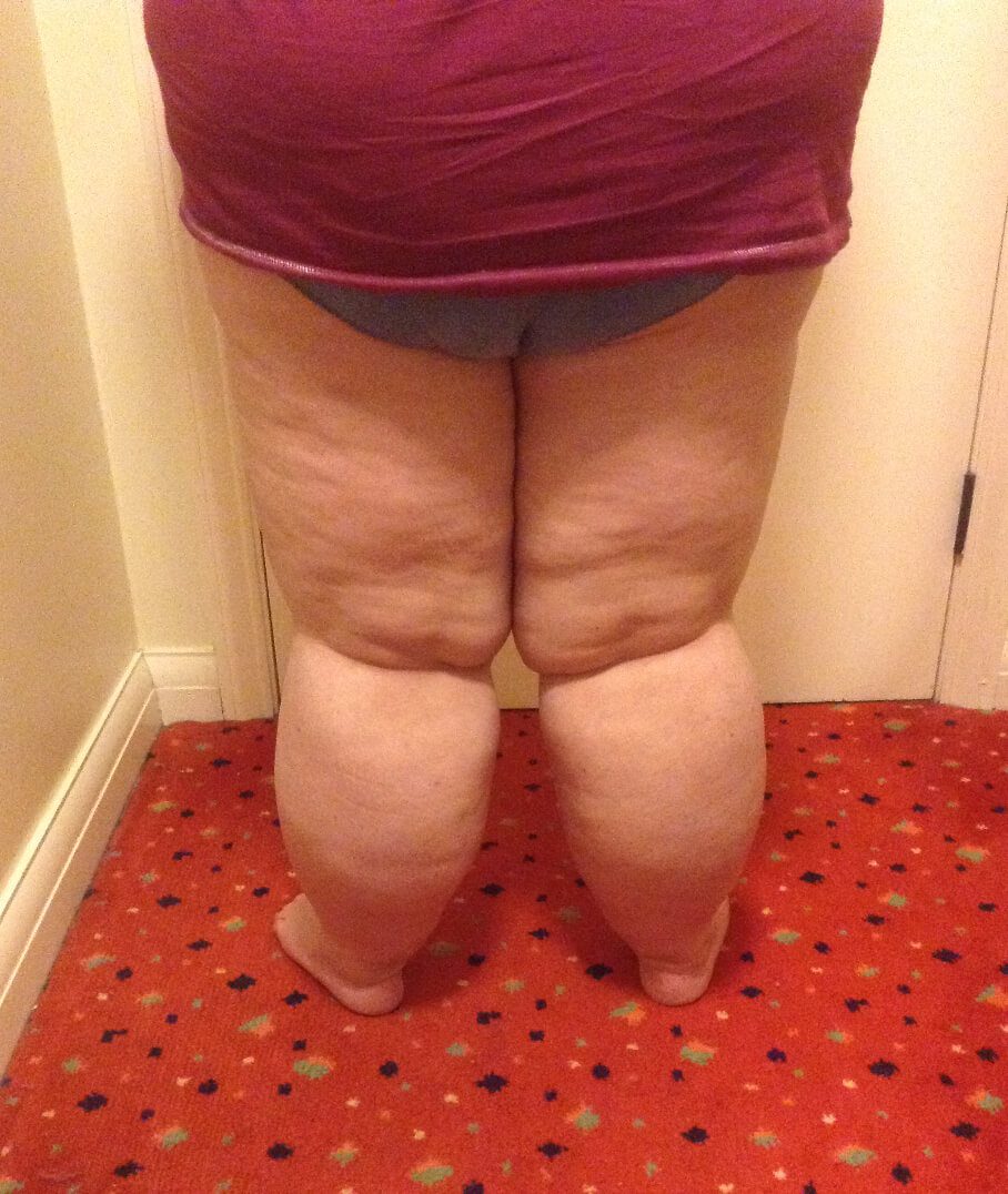 Lower limb lipoedema liposuction before posterior view