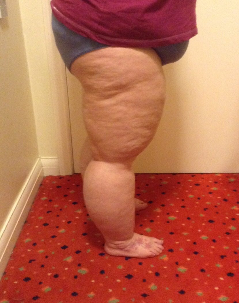 Lower limb lipoedema liposuction before right lateral