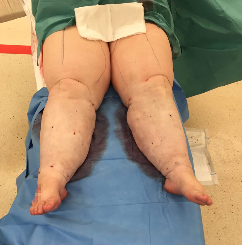 Lower limb lipoedema liposuction post op