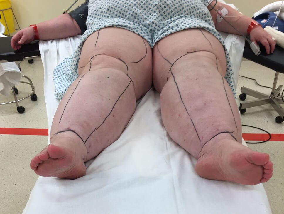 Lower limb lipoedema liposuction pre op