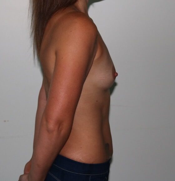 Breast enlargement before right lateral