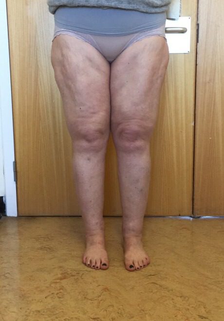 Lipoedema liposuction after AP view