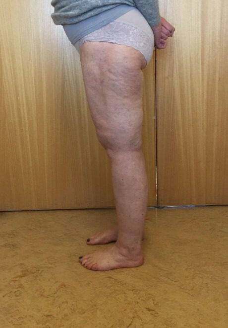 Lipoedema liposuction after left lateral