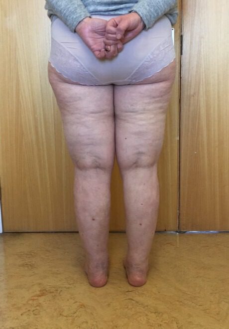 Lipoedema liposuction after posterior view