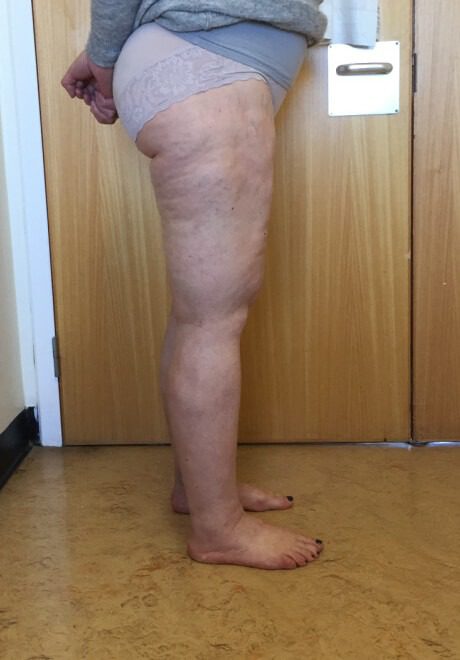 Lipoedema liposuction after right lateral