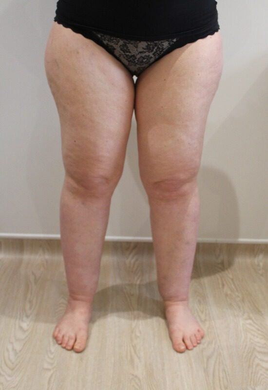 Lipoedema liposuction before AP view