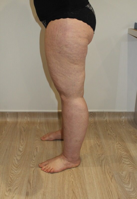 Lipoedema liposuction before left lateral