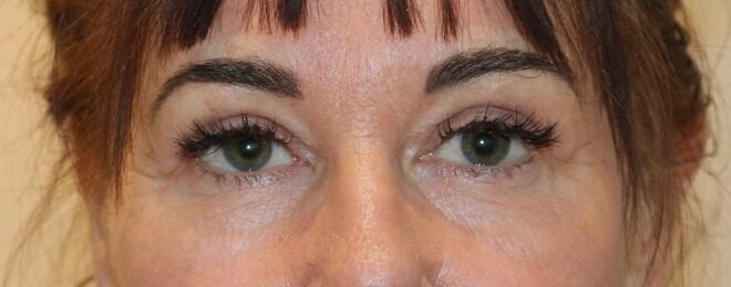 Upper blepharoplasty after AP view