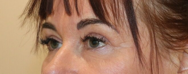 Upper blepharoplasty after left oblique