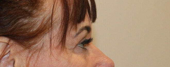 Upper blepharoplasty after right lateral