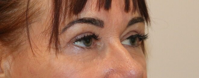 Upper blepharoplasty after right oblique