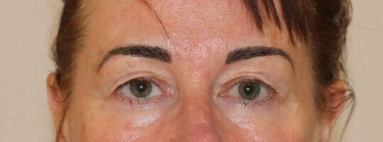 Upper blepharoplasty before AP view