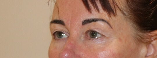 Upper blepharoplasty before left oblique