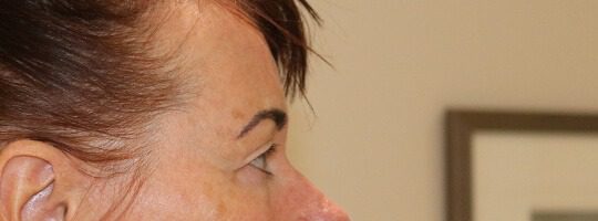 Upper blepharoplasty before right lateral