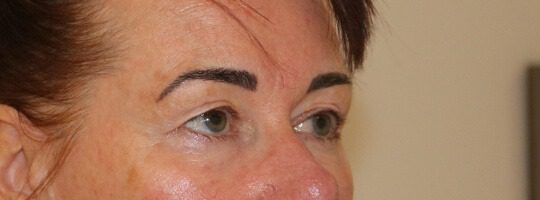 Upper blepharoplasty before right oblique