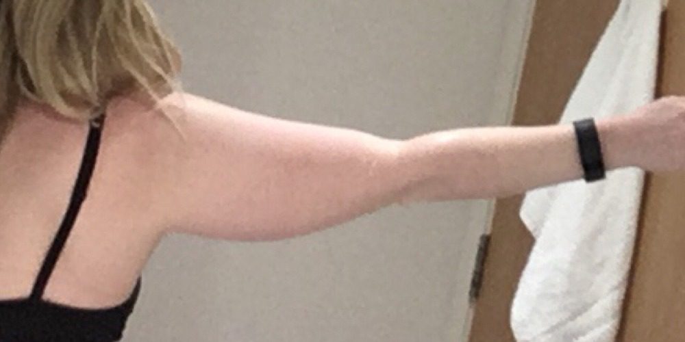 Arm lift brachiaplasty pre op