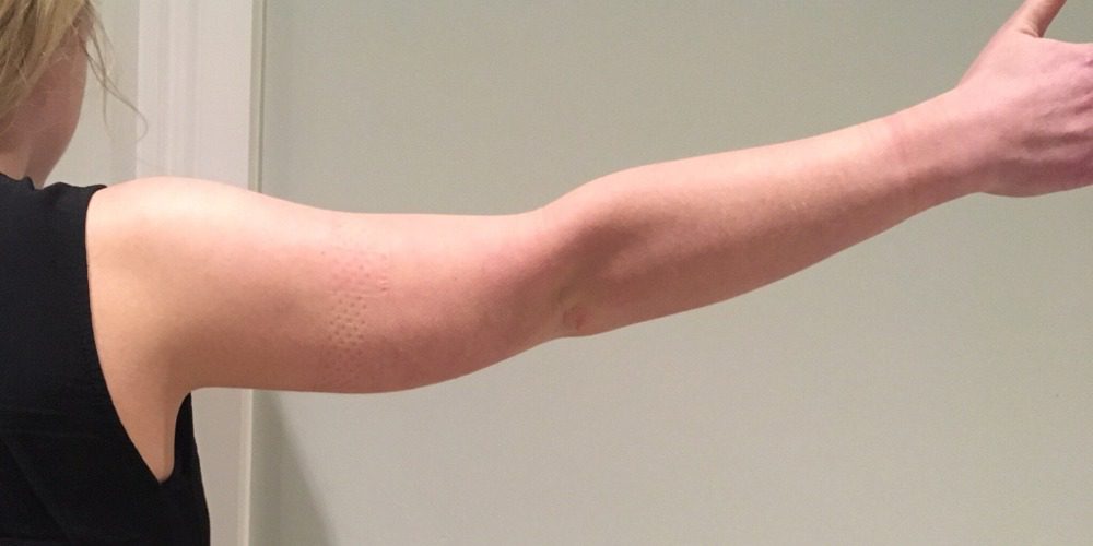 Arm lift brachioplasty post op