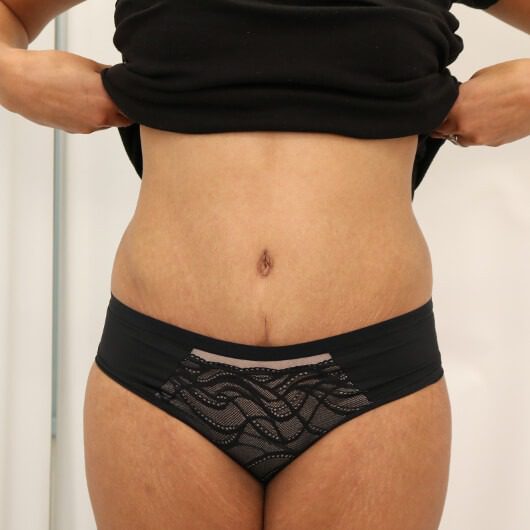 Brazilian tummy tuck after AP view 1