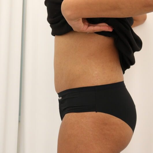 Brazilian tummy tuck after left lateral 1