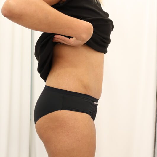 Brazilian tummy tuck after right lateral 1