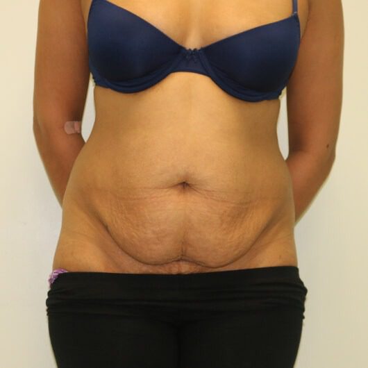 Brazilian tummy tuck before AP view 1