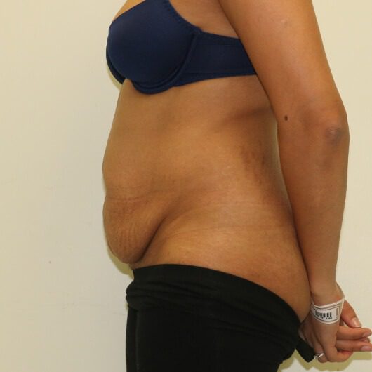 Brazilian tummy tuck before left lateral 1