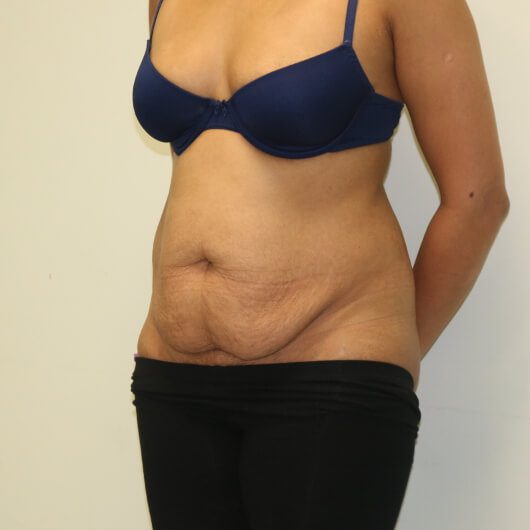 Brazilian tummy tuck before left oblique 1