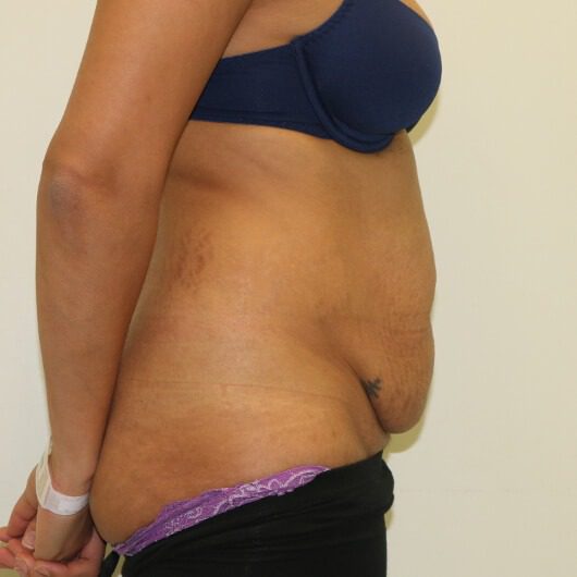 Brazilian tummy tuck before right lateral 1