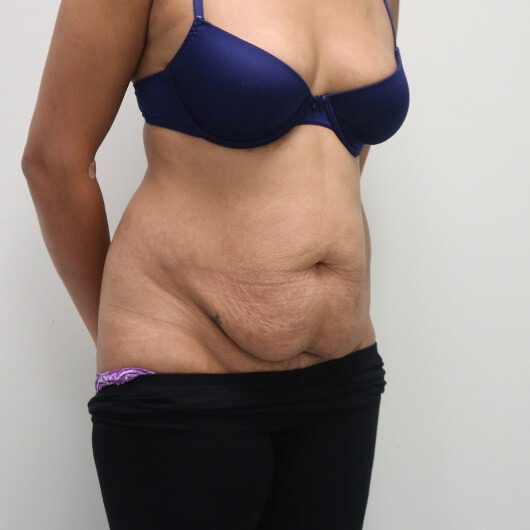 Brazilian tummy tuck before right oblique 1