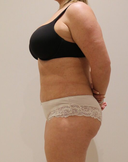 Brazilian tummy tuck post op left lateral