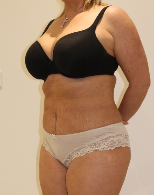Brazilian tummy tuck post op left oblique