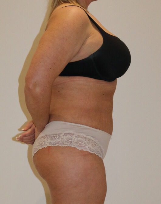 Brazilian tummy tuck post op right lateral