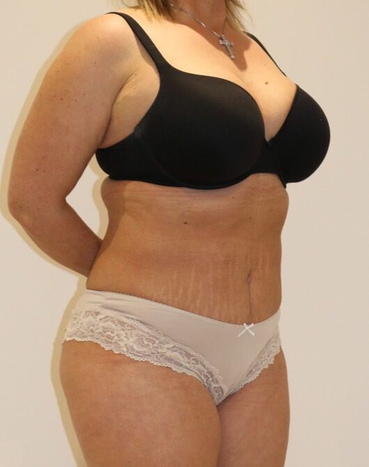 Brazilian tummy tuck post op right oblique