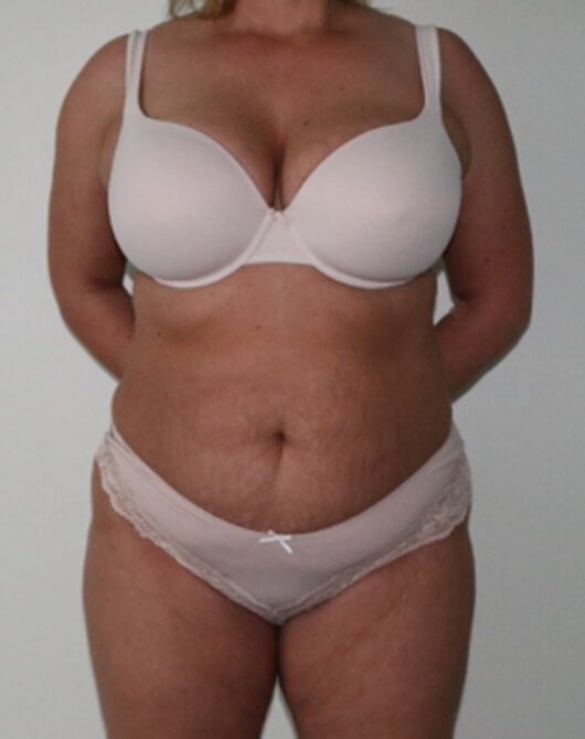 Brazilian tummy tuck pre op AP view