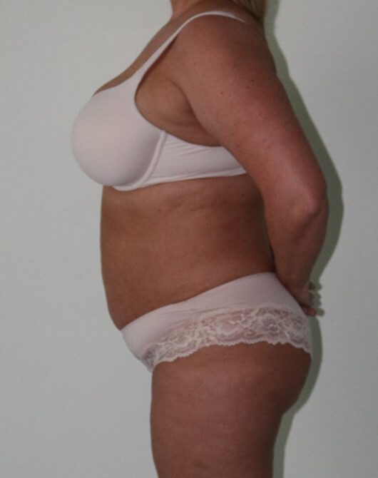 Brazilian tummy tuck pre op left lateral