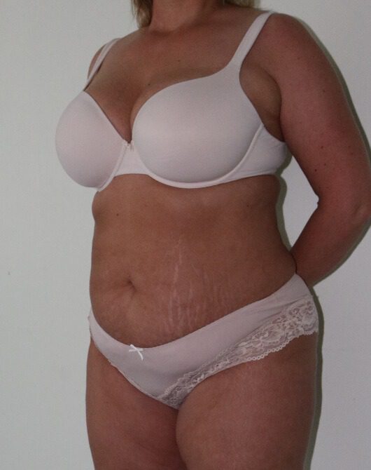 Brazilian tummy tuck pre op left oblique