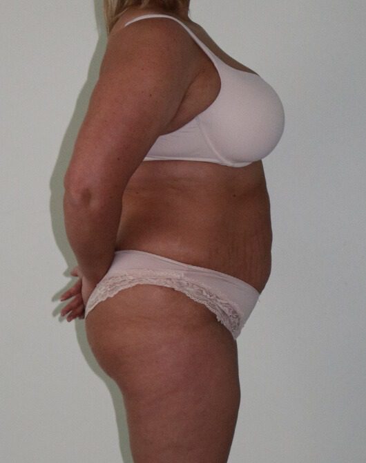 Brazilian tummy tuck pre op right lateral