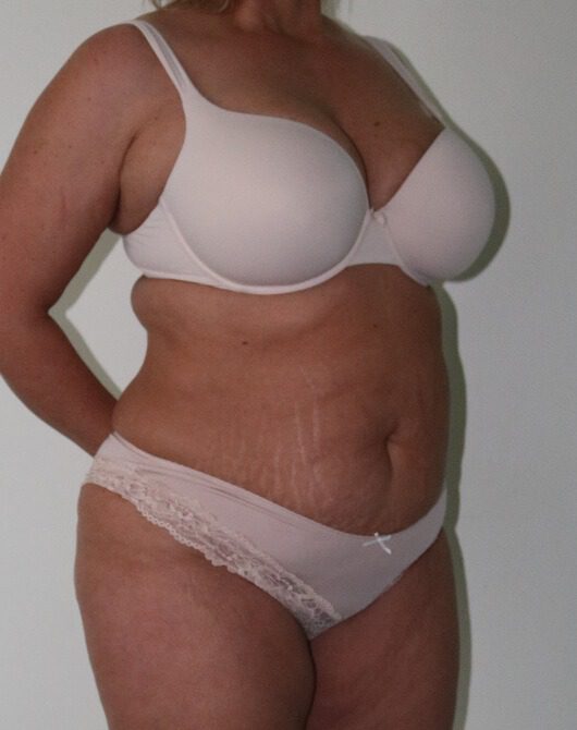 Brazilian tummy tuck pre op right oblique
