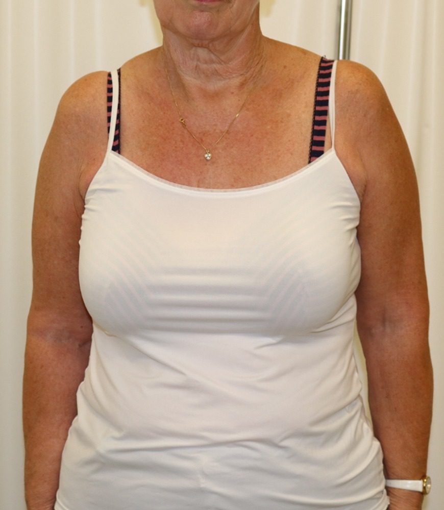 Brachioplasty after arms at sides anterior view