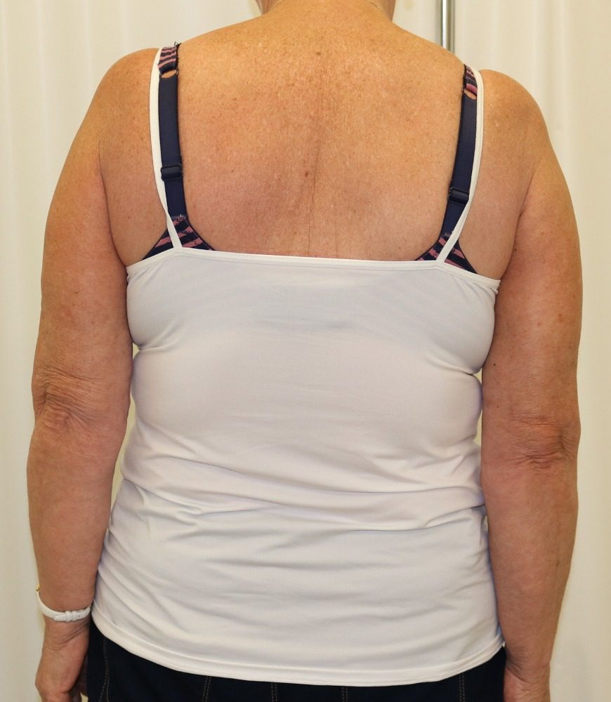 Brachioplasty after arms at sides posterior view