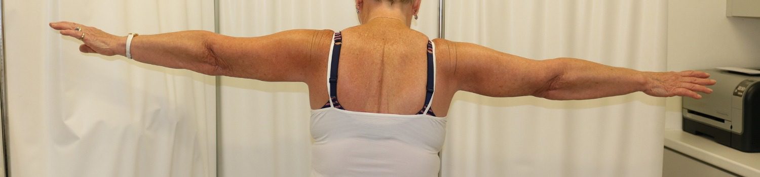 Brachioplasty after posterior view