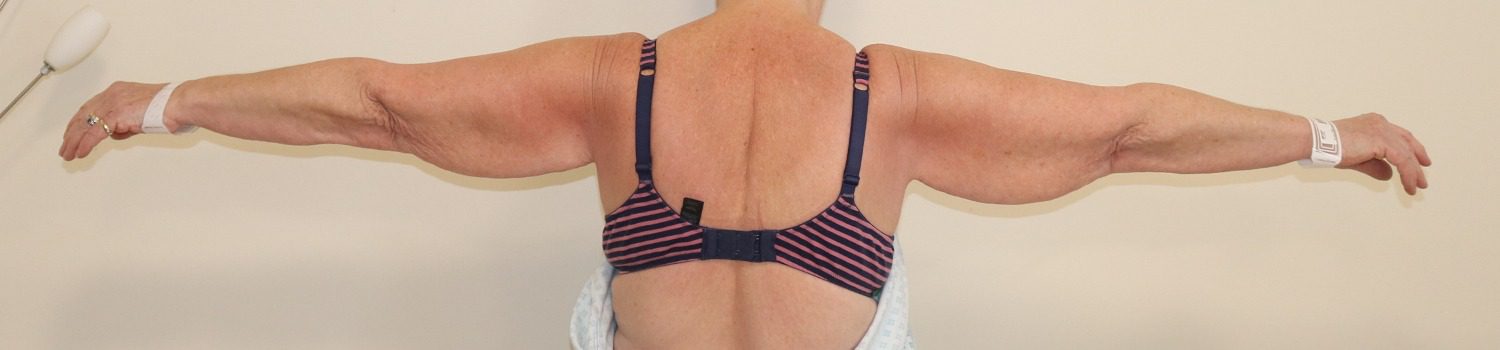 Brachioplasty before posterior view