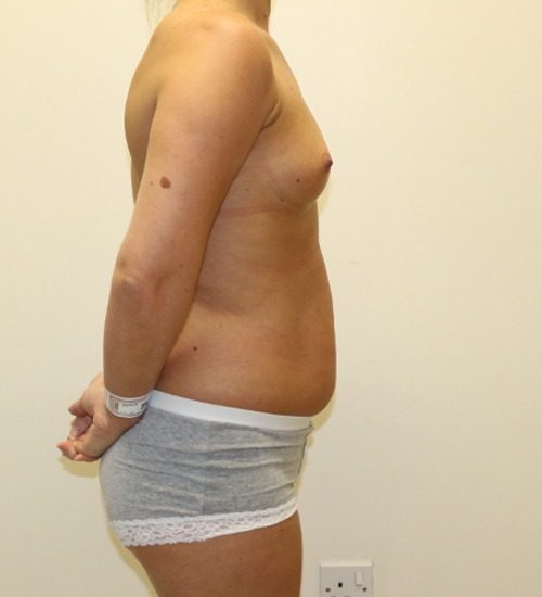 Breast enlargement abdominal liposuction mummy makeover pre op right lateral