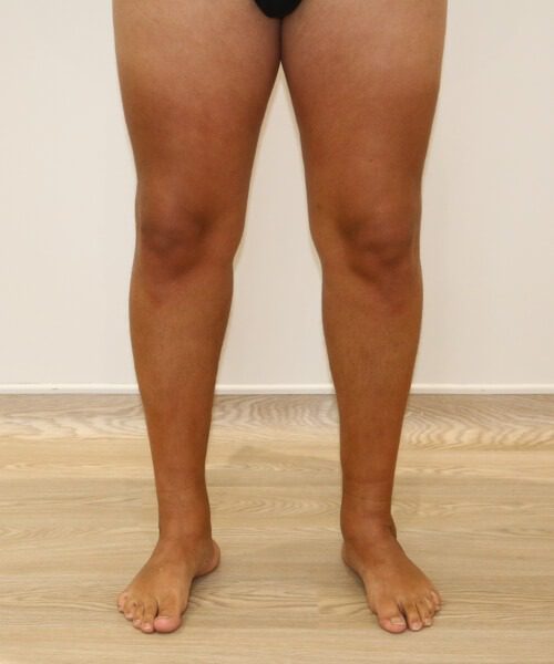 Calf implant post op AP view