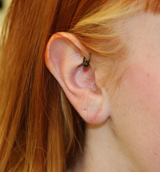 Ear plug repair post op