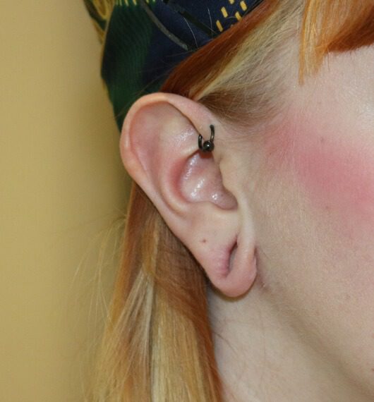 Ear plug repair pre op