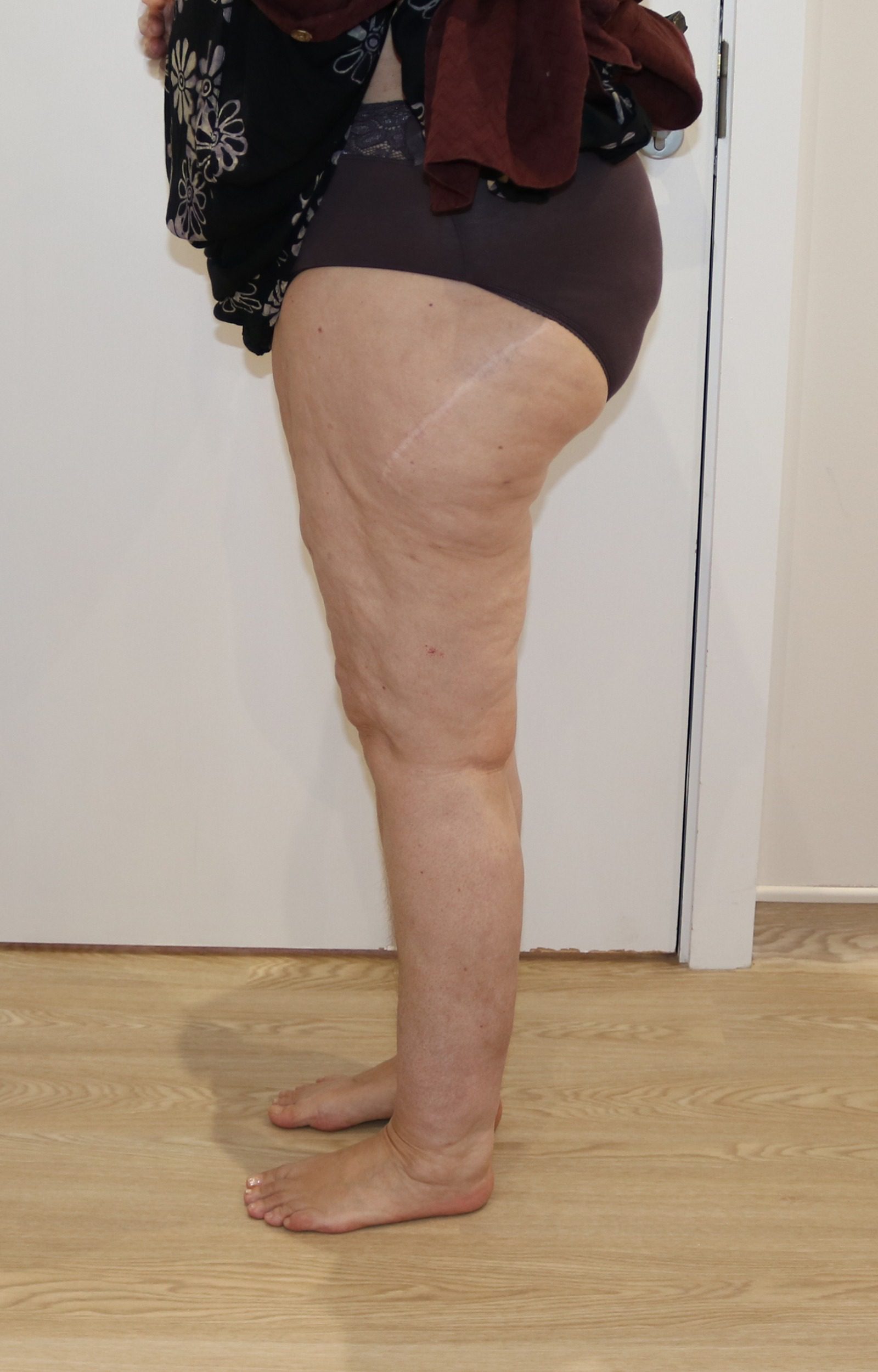 Lipoedema Type III Stage II after left lateral 1